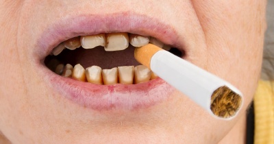 Tabac et perte de dents : les fumeurs ont 41 % de risque en plus
