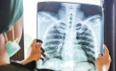 Pneumopathies associÃ©es au vapotage : comprendre les risques pulmonaires
