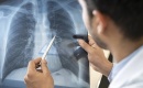 Arrêter de fumer : comprendre l’impact du tabac sur la BPCO et l’emphysème