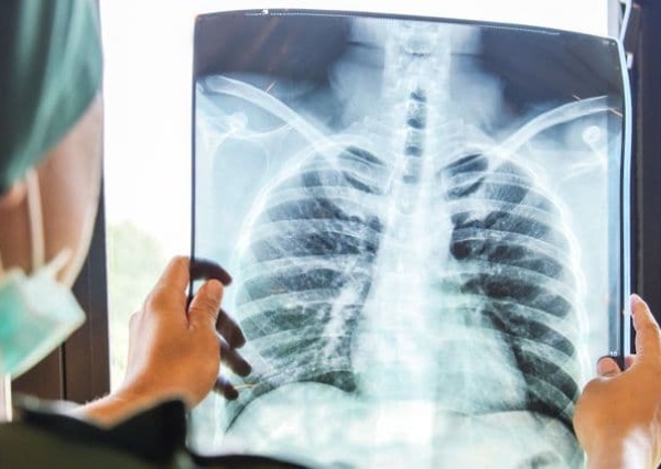Pneumopathies associÃ©es au vapotage : comprendre les risques pulmonaires